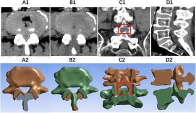 Finite element analysis of endoscopic cross-overtop decompression for single-segment lumbar spinal stenosis based on real clinical cases